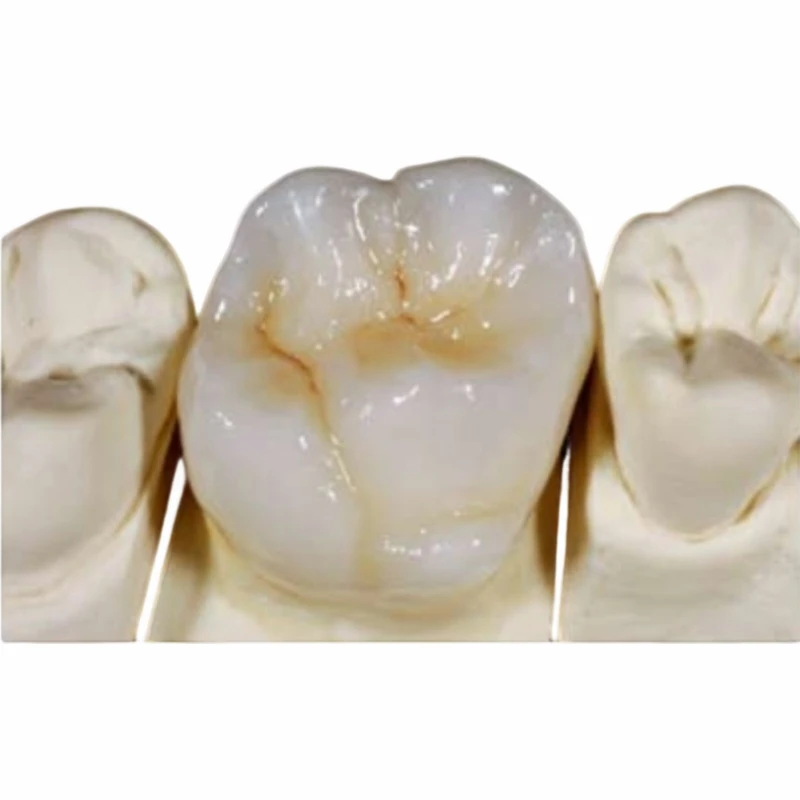 Coroana totală din ceramică IPS Emax