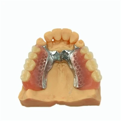 Cadru metalic parțial detașabil cu proteză dentară